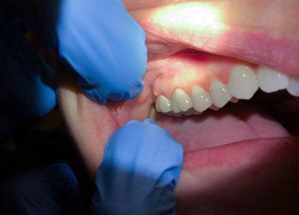 Best Lost Filling or Crown Replacement in Claypool, AZ